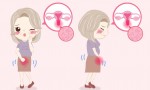 什么是子宫腺肌症？提醒女性：身体出现3个症状，说明它已找上门