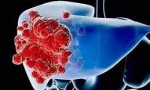 女性肝癌的症状有哪些?