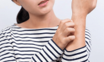 儿童反复荨麻疹发作期，注意这三点，可防止复发