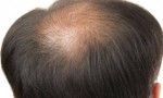 雄激素脱发的症状有哪些？ 5大具体症状表现要知道